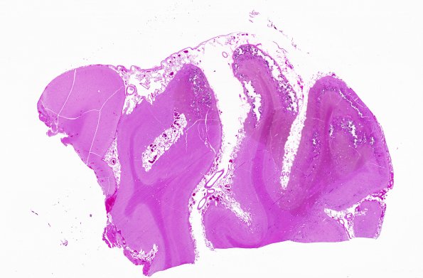 5A1 Sturge-Weber Syndrome (no facial port-wine stain, AANP 2007-8) H&E whole mount