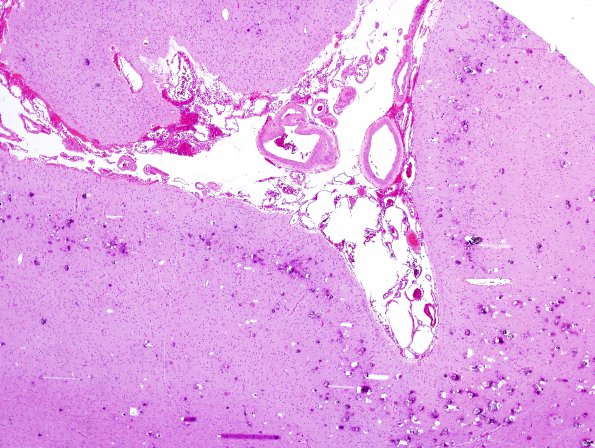 5A2 Sturge-Weber Syndrome (no facial port-wine stain, AANP 2007-8) H&E 1