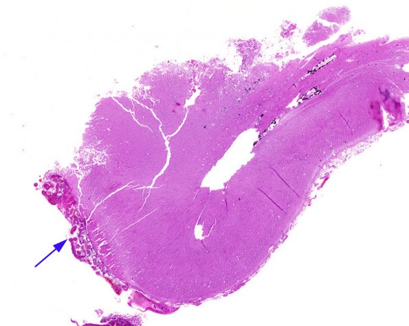 6A1 Sturge-Weber Syndrome (Case 6) b