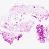 6A2 Sturge-Weber Syndrome (Case 6) a