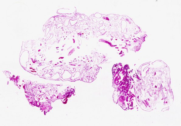 6A2 Sturge-Weber Syndrome (Case 6) a