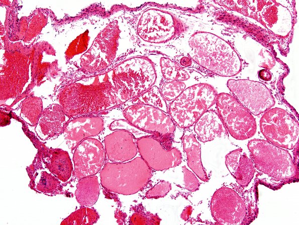 6A3 Sturge-Weber Syndrome (Case 6)c