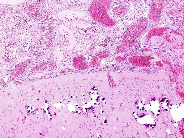 7A2 Sturge-Weber Syndrome (Case 7) 1