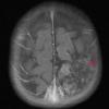 9A Sturge-Weber Syndrome (Case 9) T1W 2 - Copy 2