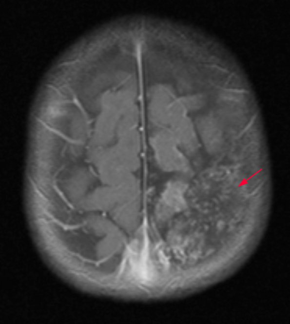 9A Sturge-Weber Syndrome (Case 9) T1W 2 - Copy 2