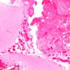 9B1 Sturge-Weber Syndrome (Case 9) H&E 1