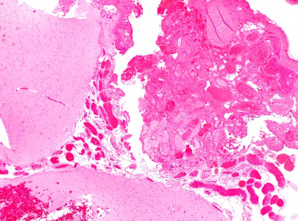 9B1 Sturge-Weber Syndrome (Case 9) H&E 1