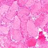 9B2 Sturge-Weber Syndrome (Case 9) H&E 3