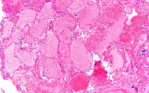 9B2 Sturge-Weber Syndrome (Case 9) H&E 3