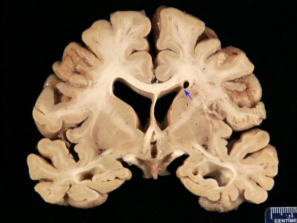 1A2 Synechia (Case 1) Gross _2