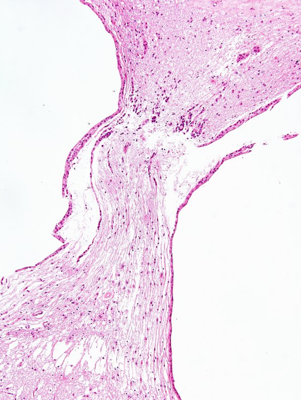 1B3 Synechia (Case 1) N12 H&E 2