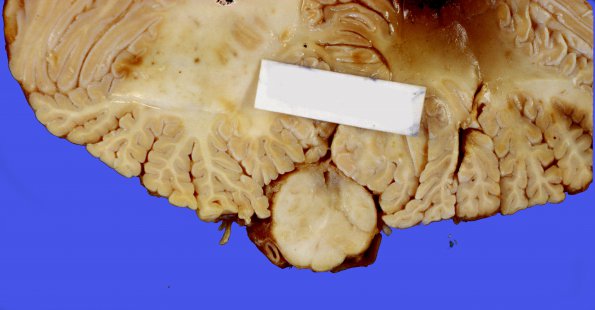 1A1 Syringobulbia (Case 1) 1