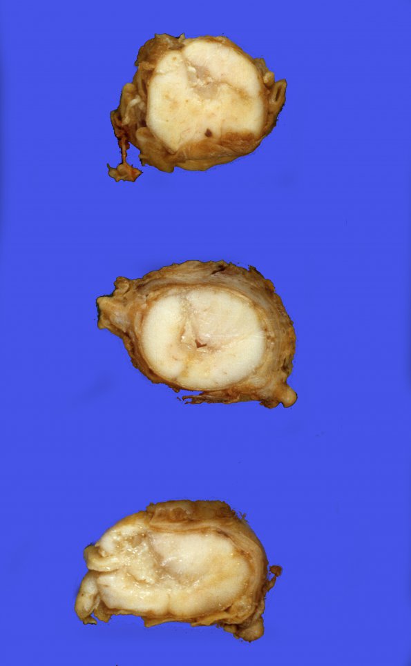 1A2 Syringomyelia (Case 1) 2