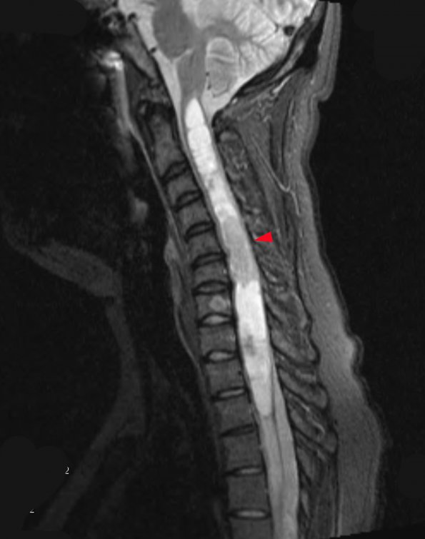 2 Ependymoma & Syrinx (Case 2) STIR