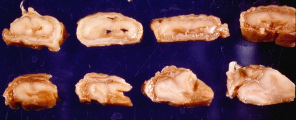 5 Syrinx with arachnoiditis (Case 5)