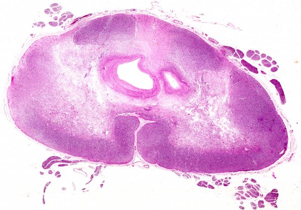 8 Syrinx (Case 8) H&E 5