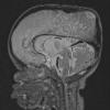 1A1 Thanatophoric dysplasia (Case 1) T2 3