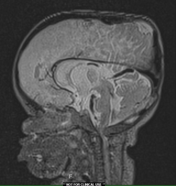 1A1 Thanatophoric dysplasia (Case 1) T2 3