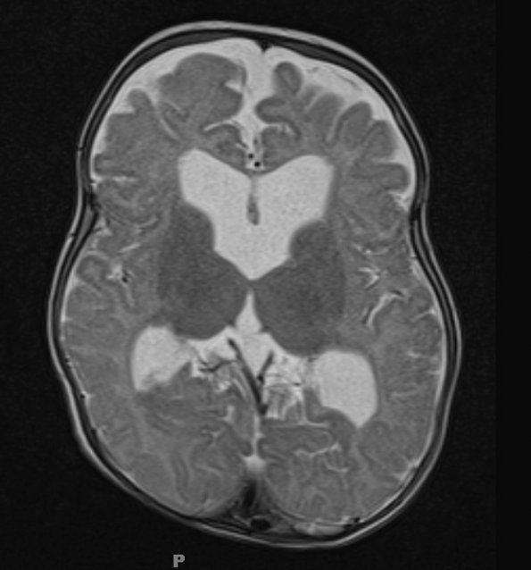 1A2 Thanatophoric dysplasia (Case 1) T2 2