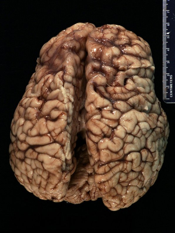 1C1 Thanatophoric dysplasia (Case 1) _9