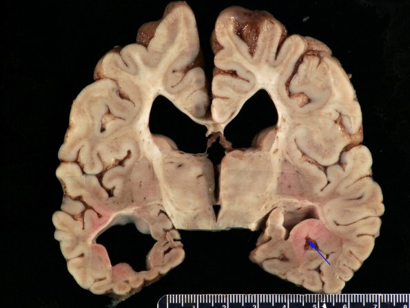 1C2 Thanatophoric dysplasia (Case 1) _19