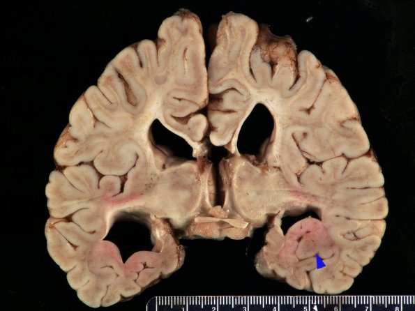 1C3 Thanatophoric dysplasia (Case 1) _20