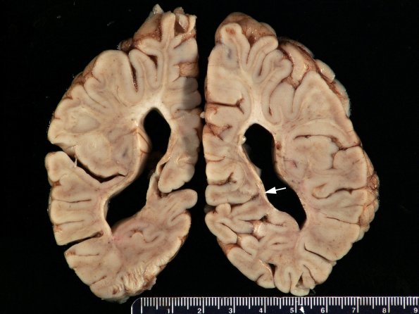 1C4 Thanatophoric dysplasia (Case 1) _22