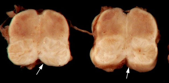 1C5 Thanatophoric dysplasia (Case 1) _15