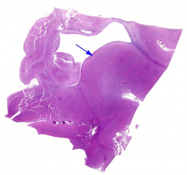 1D1 Thanatophoric dysplasia (Case 1) N3 H&E whole mount