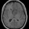 10A1 Tuberous sclerosis (Case 10, SEGA) T1