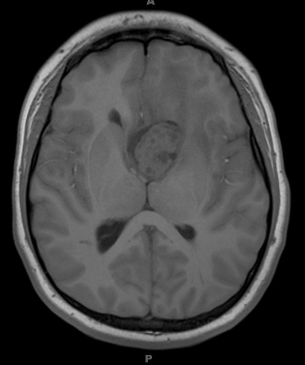 10A1 Tuberous sclerosis (Case 10, SEGA) T1