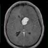 10A2 Astrocytoma, Tuberous Sclerosis (Case 10) MRI 6