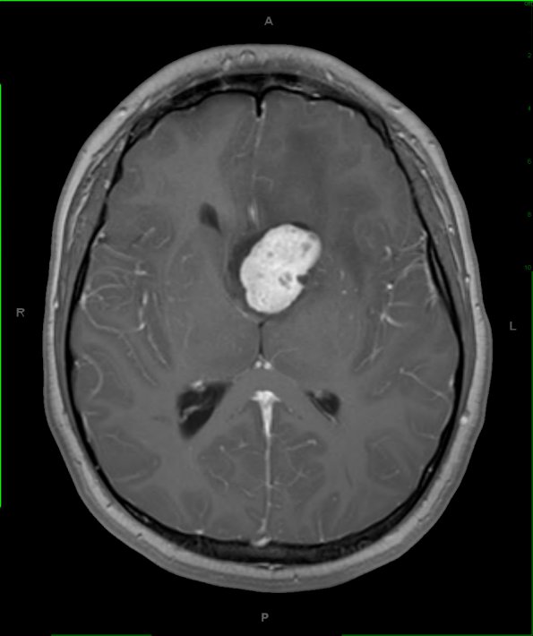 10A2 Astrocytoma, Tuberous Sclerosis (Case 10) MRI 6