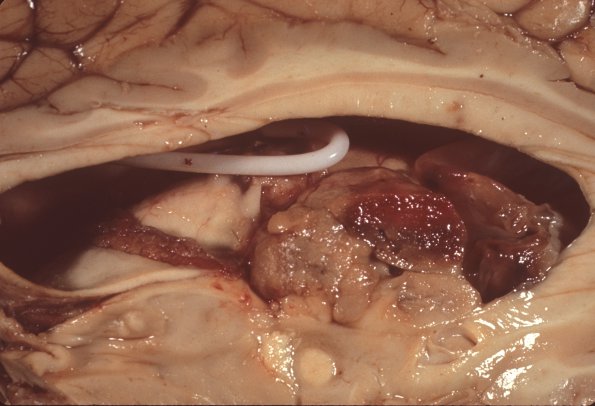 11 Subependymal Giant Cell Astrocytoma (SEGA) (Case 11) 3 - Copy