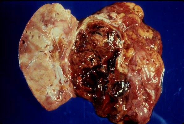 12 Kidney Tuberous Sclerosis (Case 12) Angiomyolipoma