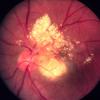 14A Eye,Tuberous Sclerosis, Astocytic Hamartoma,  (Case 14)