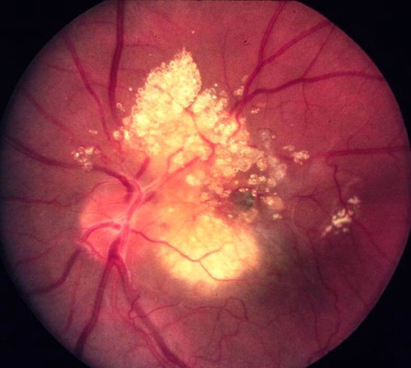 14A Eye,Tuberous Sclerosis, AstocyticHamartoma,  (Case 14)