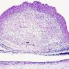 14B Tuberous Sclerosis, Retinal Astrocytic Hamartoma (Case 14)