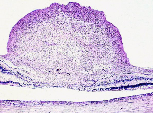 14B Tuberous Sclerosis, Retinal Astrocytic Hamartoma (Case 14)