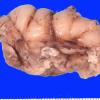 15B1 Tuberous sclerosis (Case 15) Gross