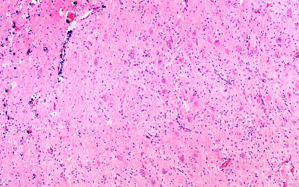 15C4 Tuberous sclerosis (Case 15) H&E A2