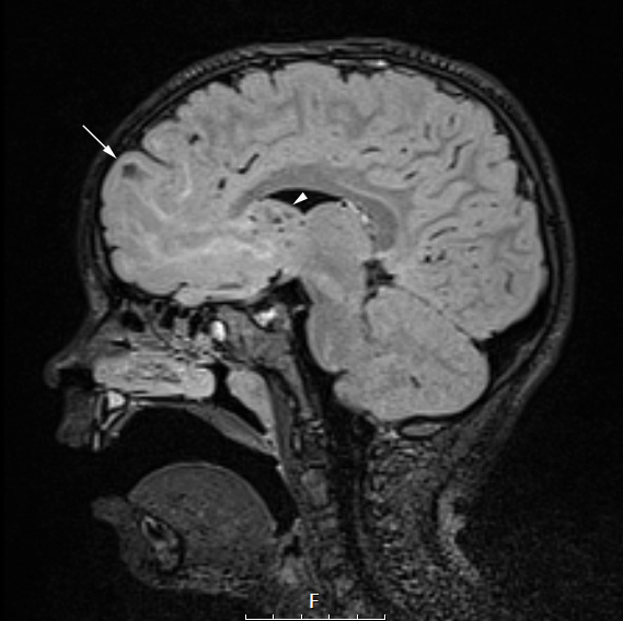 16A1 TS & SEGA (Case 16) FLAIR WA - Copy copy