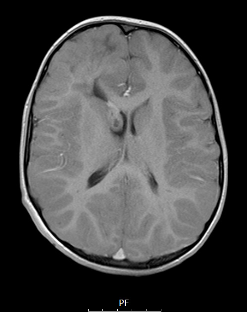 16A4 TS & SEGA (Case 16) T1W axial A - Copy