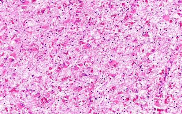 16B11 Tuber (Case 16) H&E 20X 2