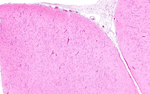 16B2 Tuber (Case 16) 4X H&E