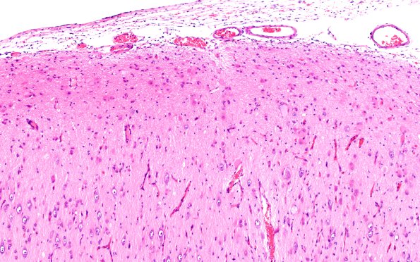 16B3 Tuber (Case 16) H&E 10X