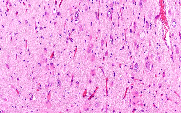 16B5 Tuber (Case 16) H&E 20X