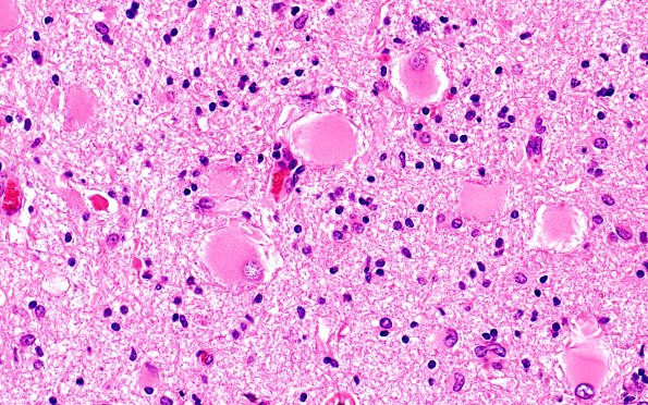 16B7 Tuber (Case 16) H&E 40X 2