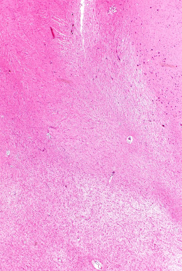 16B8 Tuber (Case 16) H&E 2XA