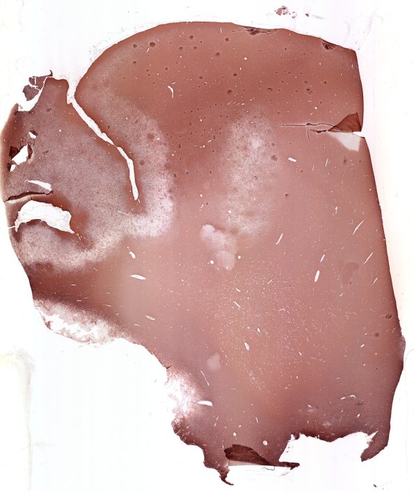 16C1 Tuber (Case 16) WM GFAP